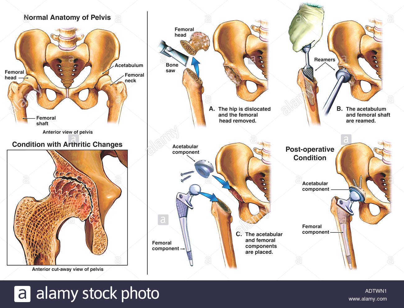 What Is Total Hip Arthroplasty?