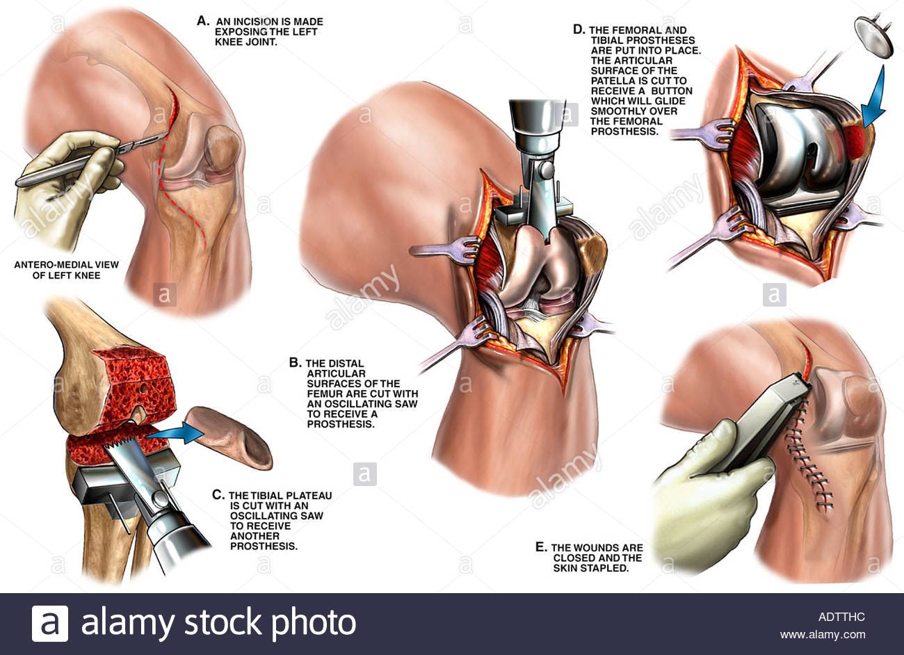 Causes of Total Knee Arthroplasty