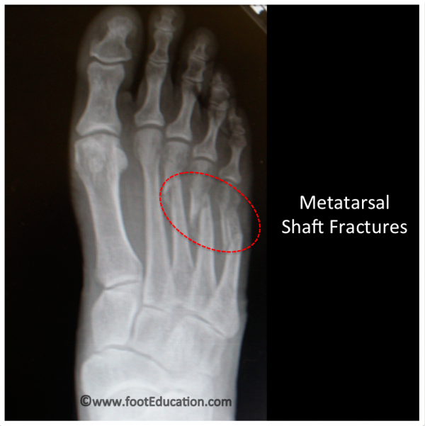 March Fractures - Causes, Symptoms, Diagnosis, Treatment