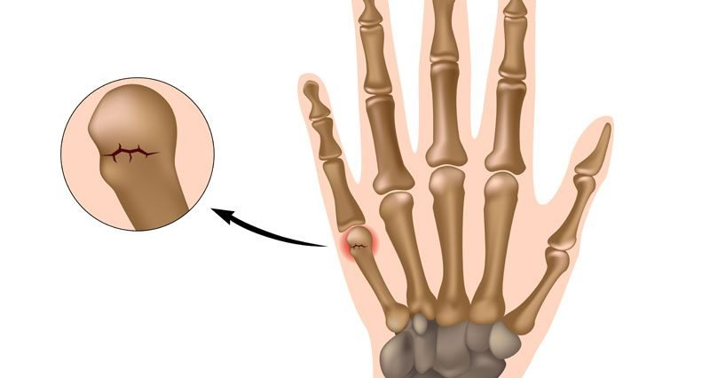 Metacarpal Fractures - Causes, Symptom, Treatment