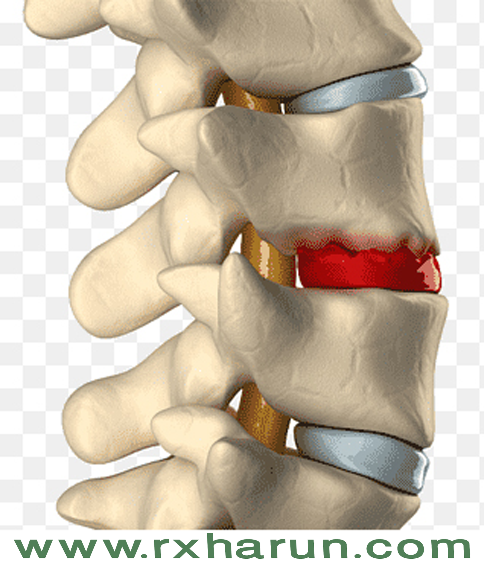 Degenerative Disc - Causes, Symptoms, Diagnosis, Treatment