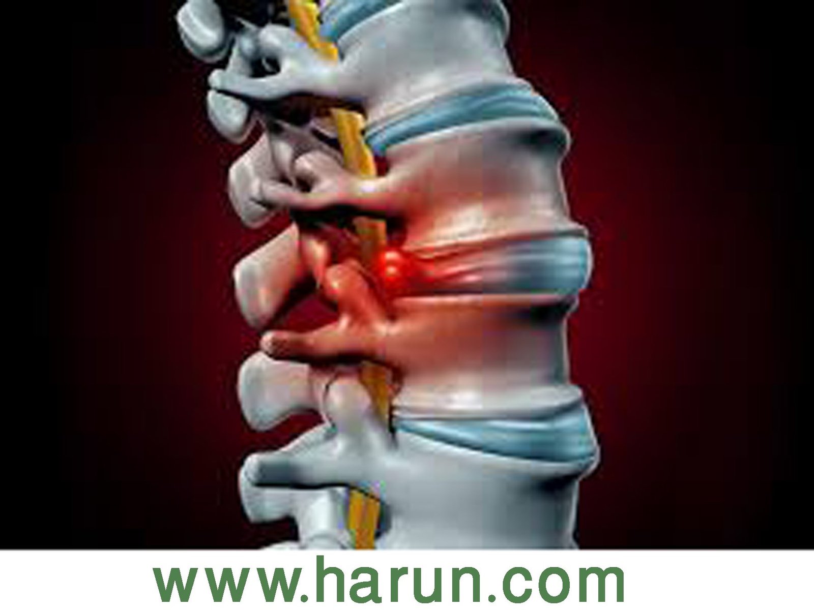 Degenerative Disc - Causes, Symptoms, Diagnosis, Treatment