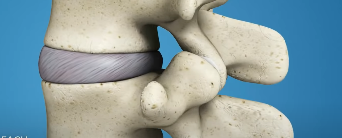 Failed Back Surgery Syndrome - Symptoms, Treatment