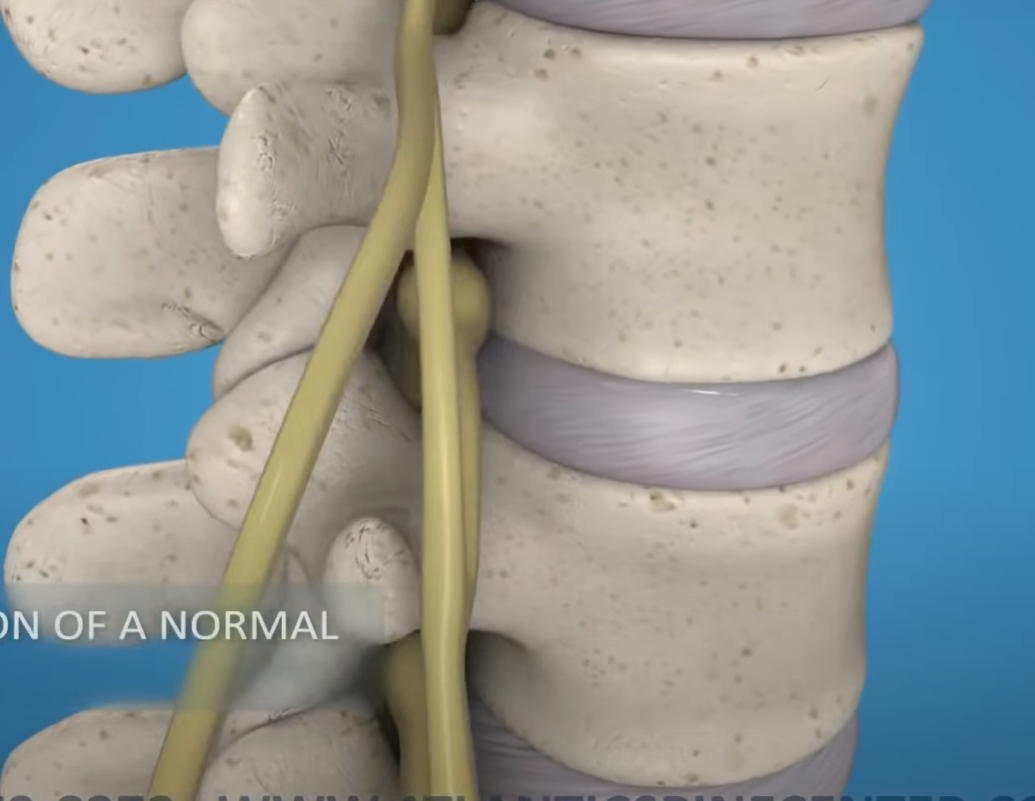 Failed Back Surgery Syndrome - Symptoms, Treatment