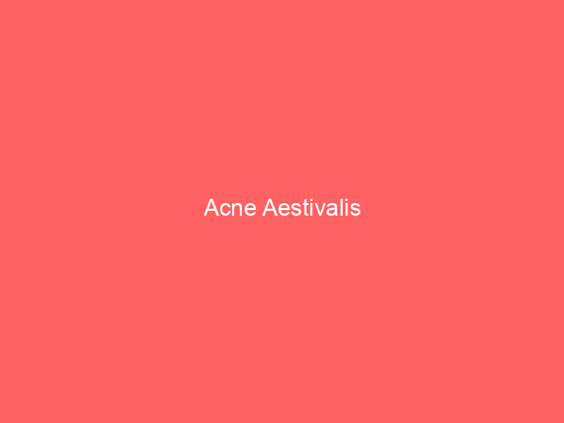 Acne Aestivalis