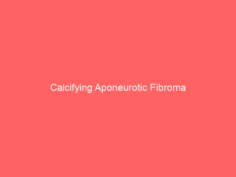 Calcifying Aponeurotic Fibroma