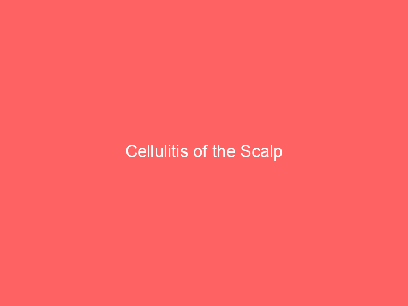 Cellulitis of the Scalp