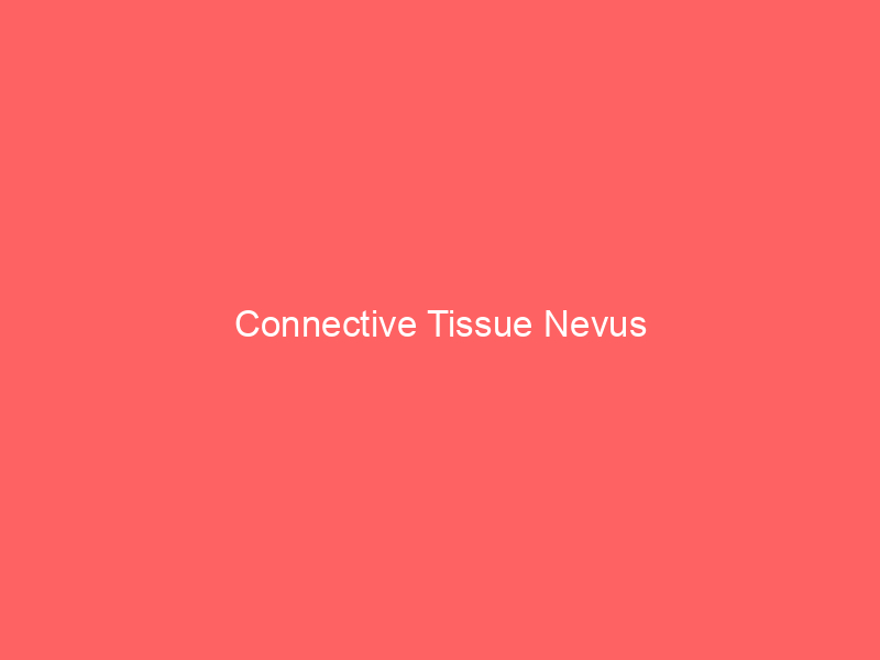Connective Tissue Nevus