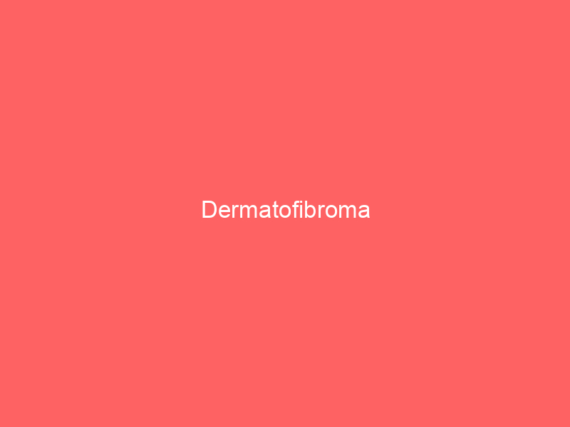 Dermatofibroma