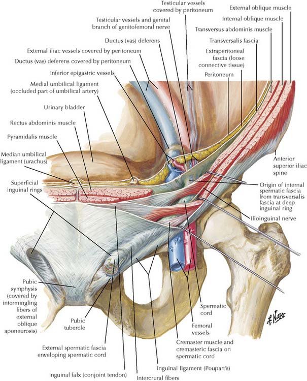 Inguinal Triangle Hyperplasia