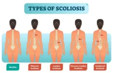 3952-scoliosis_types_100585862_ml-768x498