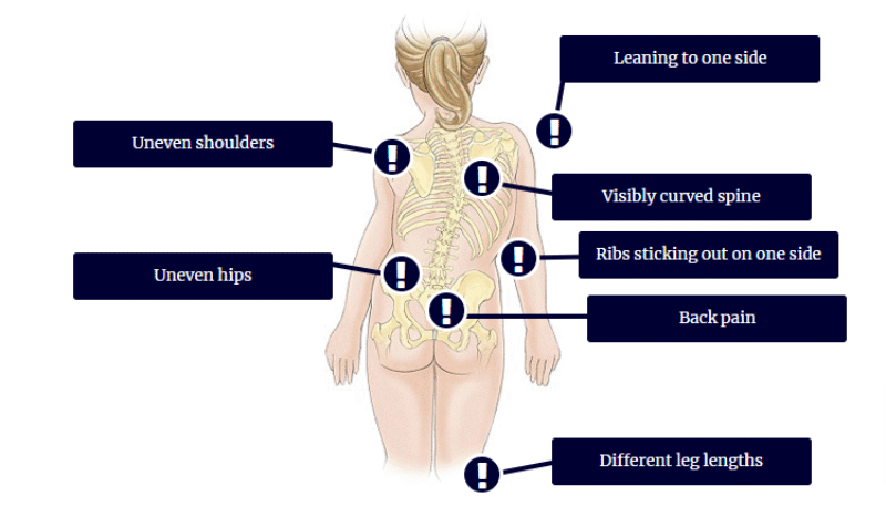 Scoliosis - Causes, Symptoms, Diagnosis, Treatment