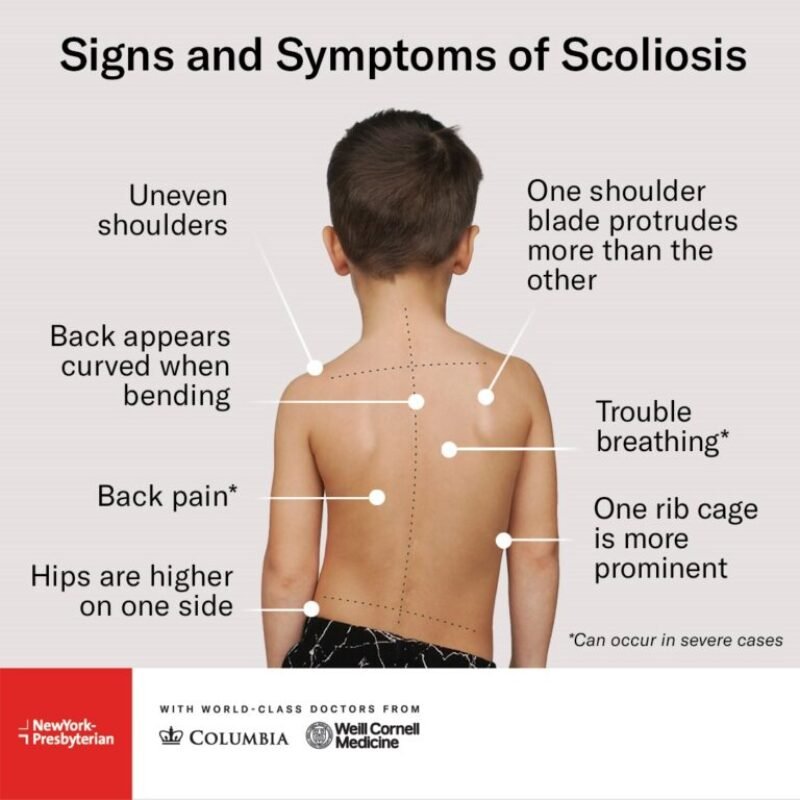 Scoliosis - Causes, Symptoms, Diagnosis, Treatment