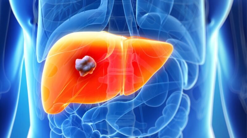 Liver Cancer: Symptoms, Causes, Treatment, and Prognosis